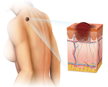 Skin Cancer Diagram